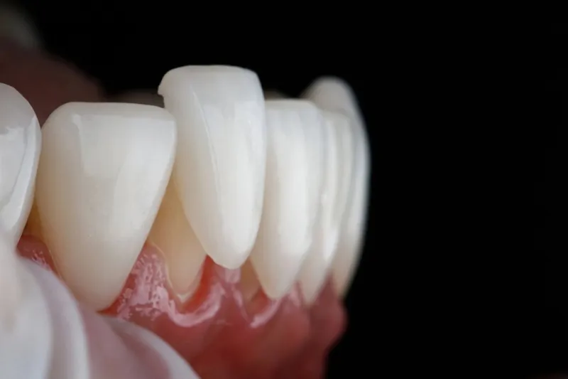 Les facettes abîment-elles les dents ? La réponse honnête