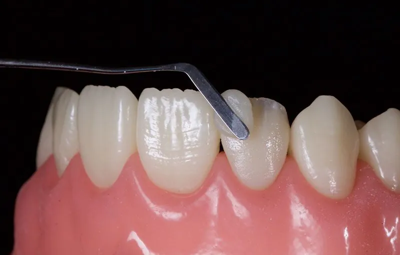 Restauration en composite stratifié direct sculpté en cabinet par le chirurgien-dentiste - finition manuelle au spatule