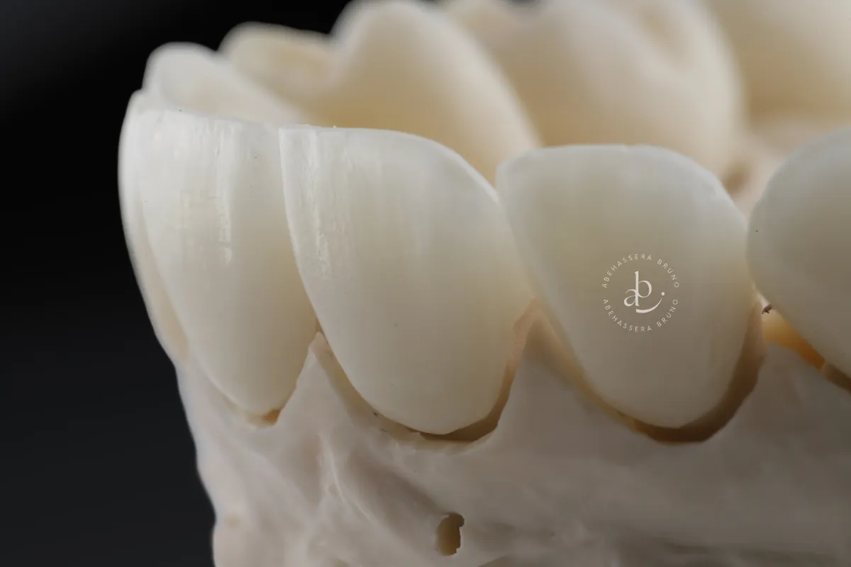 Détail de facettes céramiques montrant la translucidité proche de l'émail naturel