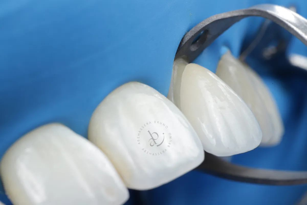Pose d'une facette céramique sur dent antérieure, cabinet de dentisterie esthétique à Levallois-Perret