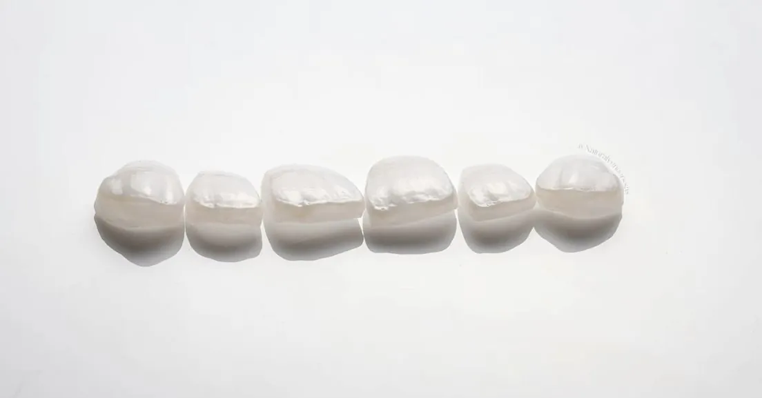 Six facettes dentaires céramiques haute résistance avant collage en laboratoire prothétique