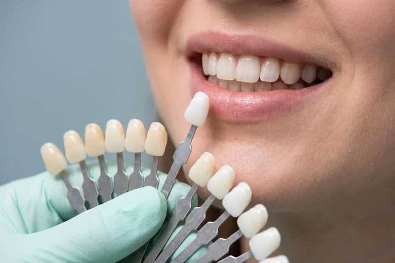 Facettes ou blanchiment : que choisir ?