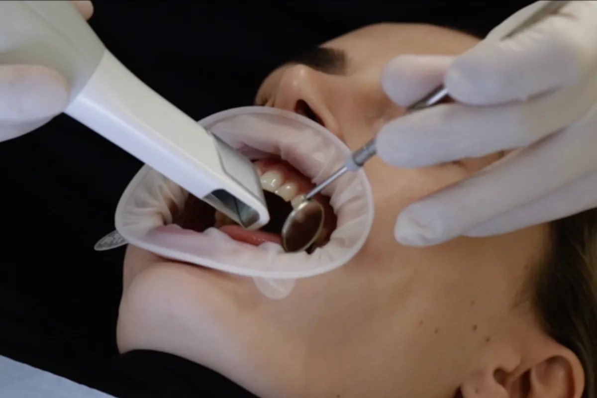 Empreinte numérique réalisée au scanner intra-oral au cabinet à Levallois-Perret pour la pose de facettes dentaires.