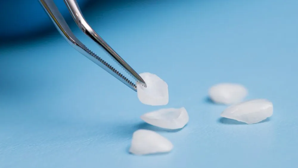 Facettes céramiques pelliculaires e.max sortant du laboratoire avant collage : variabilité du prix selon le matériau choisi