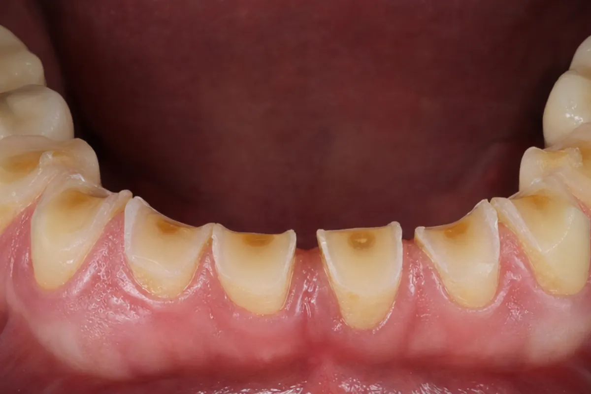 Usure dentaire généralisée avec cupules et dentine exposée sur les dents inférieures, avant réhabilitation à Levallois-Perret