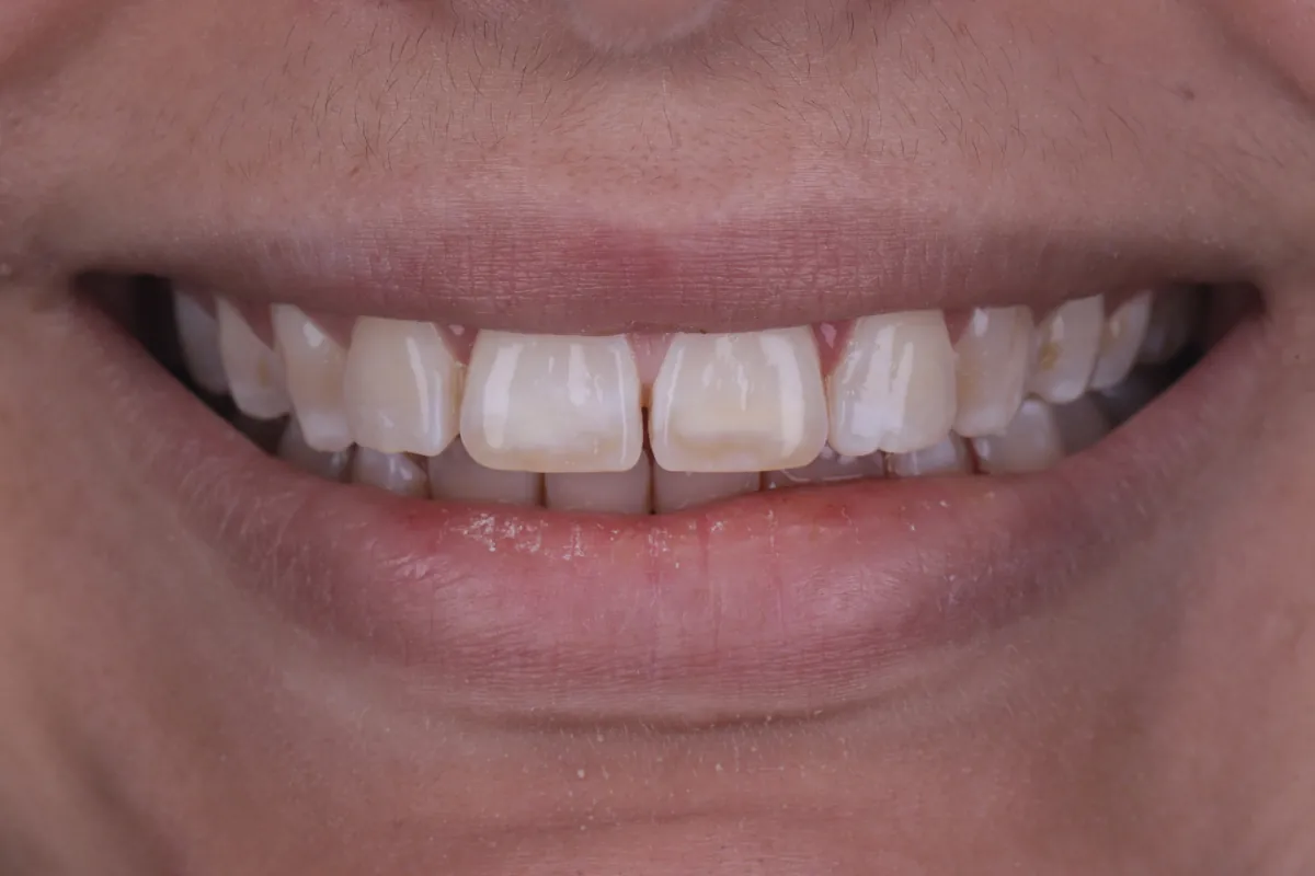 Taches blanches sur les dents chez l'adulte : opacités discrètes sur les incisives supérieures, patientèle Paris-Ouest