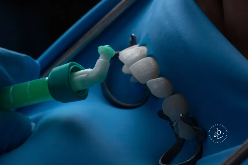 Taches blanches sur les dents : le traitement Icon en une seule séance