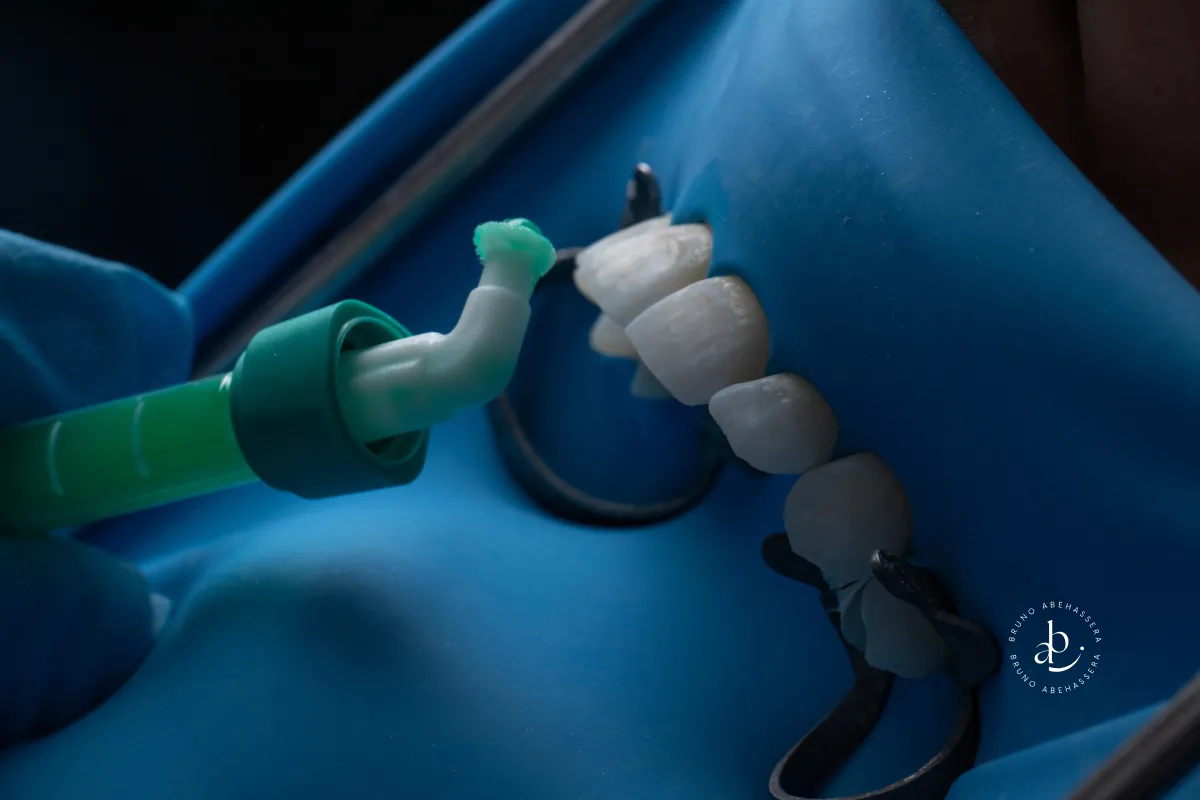 Taches blanches sur les dents : le traitement Icon en une seule séance