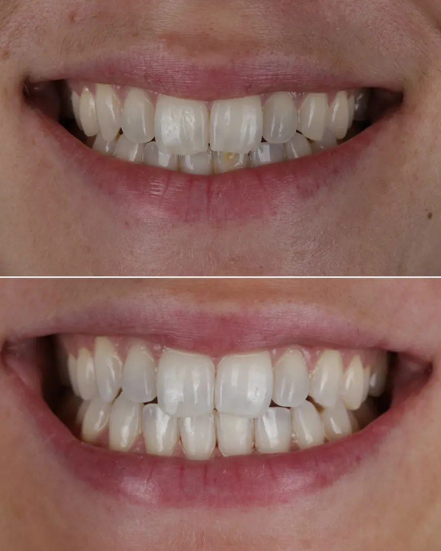 Cas clinique de correction de dyschromie localisée par composite stratifié, avant et après traitement