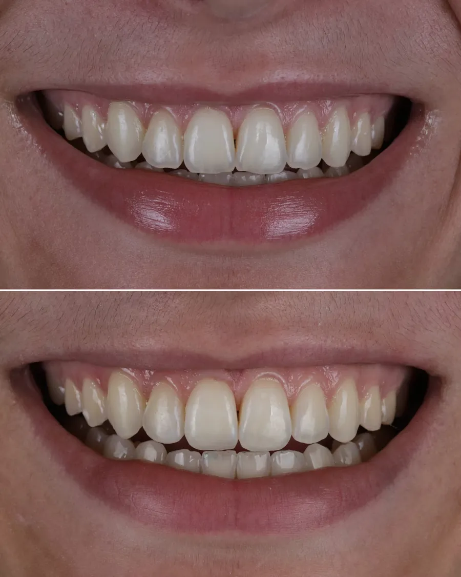 Cas clinique de correction de la forme et des proportions d'une dent par composite stratifié, avant et après traitement
