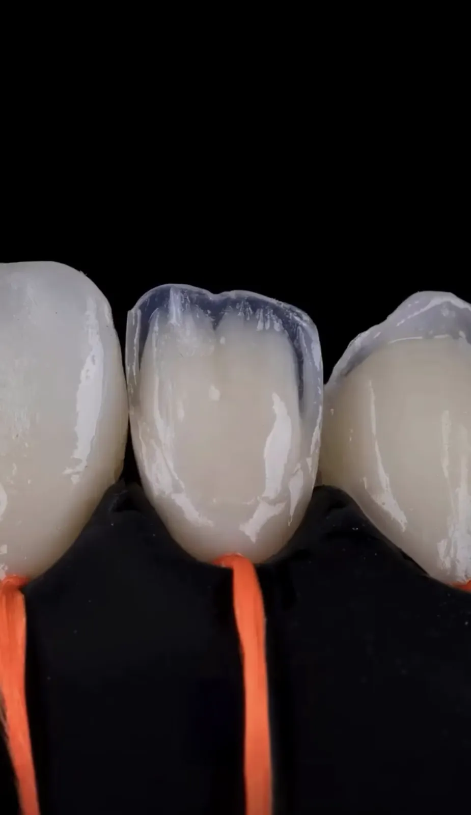 Dent restaurée par stratification couche par couche reproduisant la dentine, l'émail et la translucidité naturelle au cabinet du Dr Bruno Abehassera