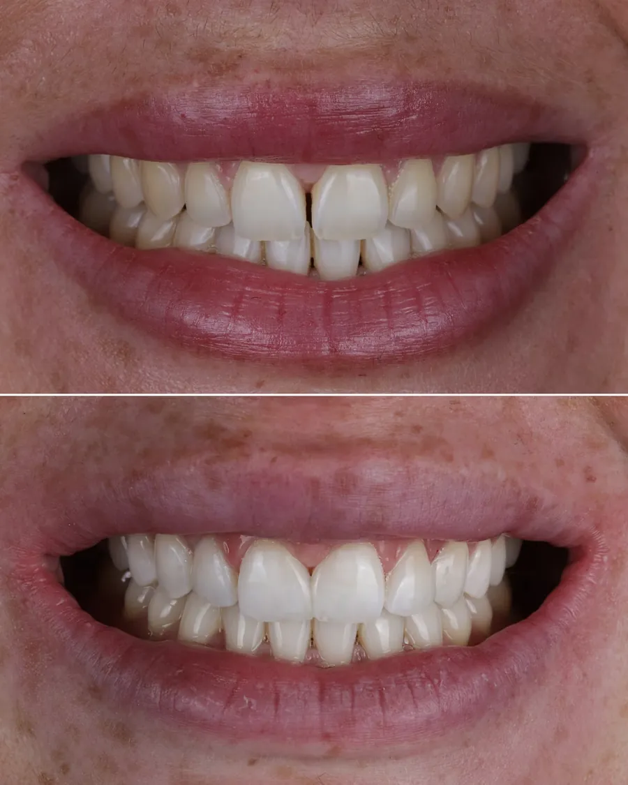 Cas clinique de fermeture de diastème par composite stratifié, avant et après traitement