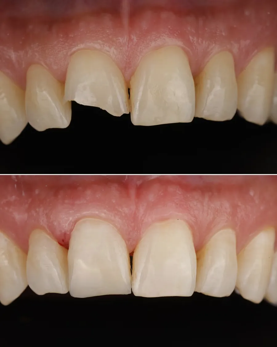 Cas clinique de reconstruction par composite stratifié après fracture ou perte tissulaire réalisé à Levallois-Perret, avant et après traitement