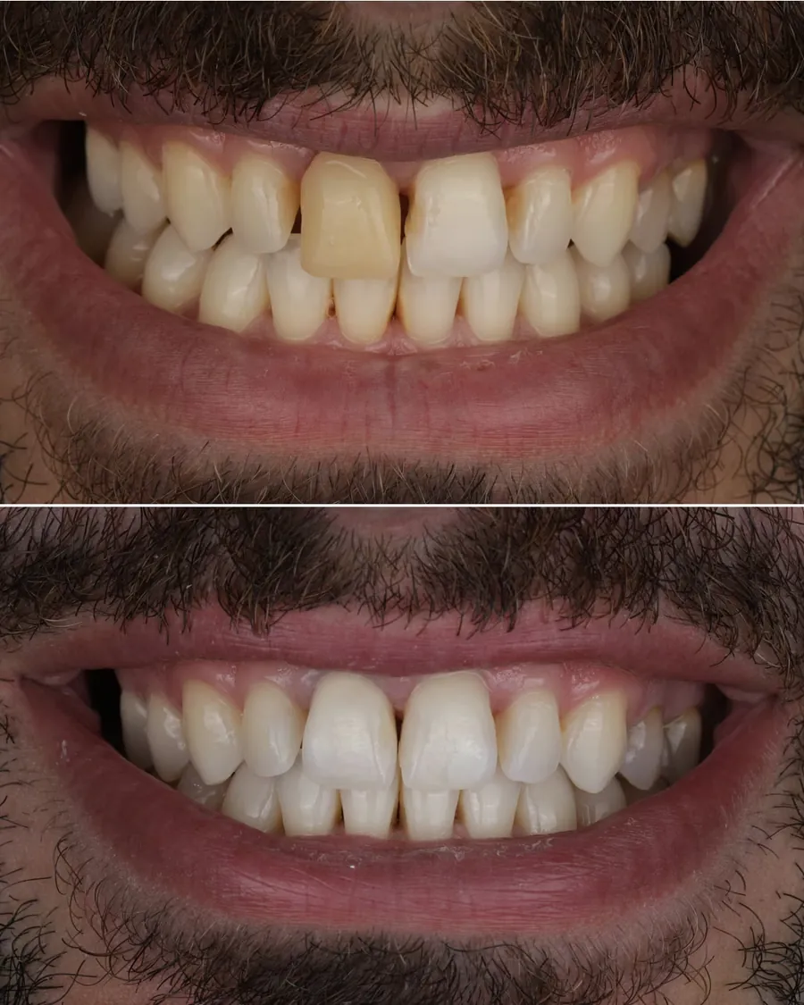Cas clinique d'éclaircissement dentaire préalable à la pose de facettes ou composites, avant et après traitement