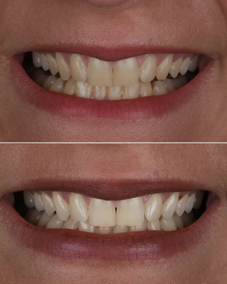 Cas clinique d'éclaircissement dentaire pour vieillissement naturel des dents, avant et après traitement