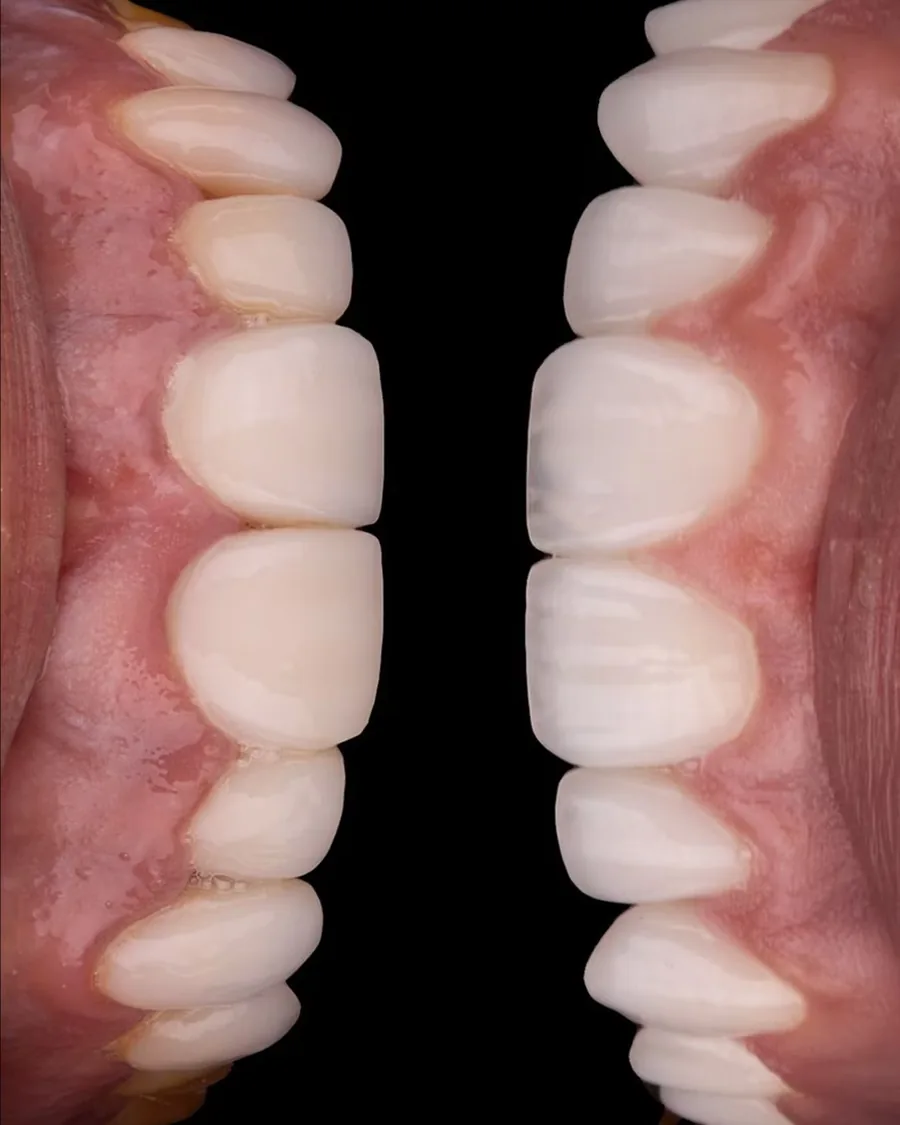Photographie clinique d'anciennes restaurations en composite ayant mal vieilli, indication de remplacement par des facettes céramiques