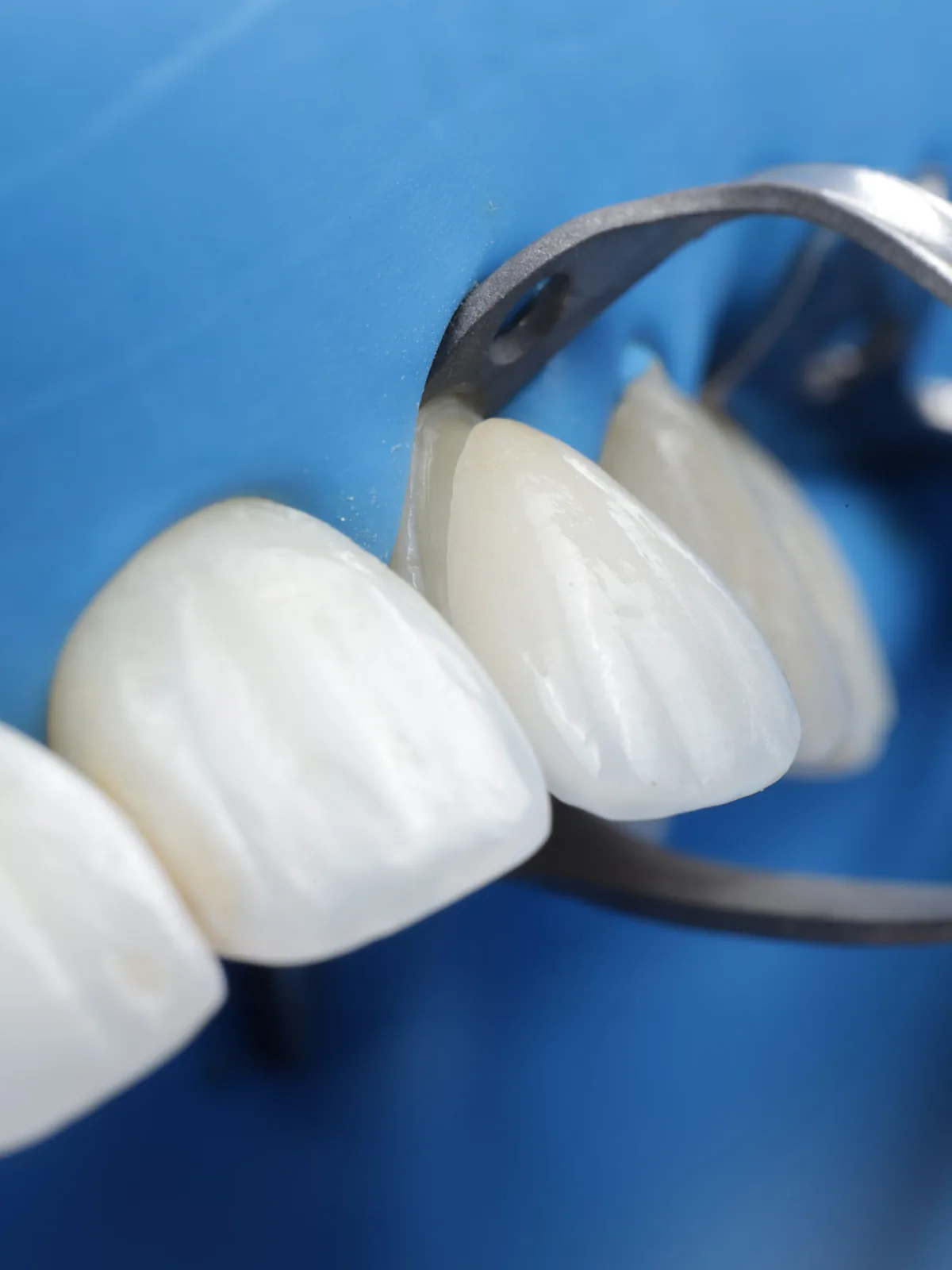 Essayage d'une facette céramique pelliculaire de 0,5 mm sur dent antérieure au cabinet du Dr Bruno Abehassera à Levallois-Perret