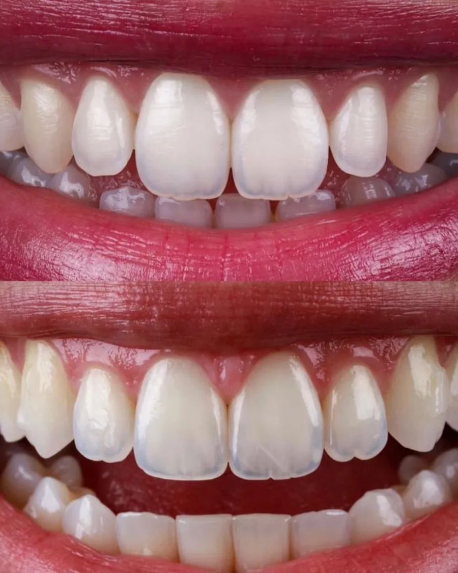 Photographie clinique illustrant des malpositions dentaires et diastèmes, indication de facettes céramiques en alternative à l'orthodontie