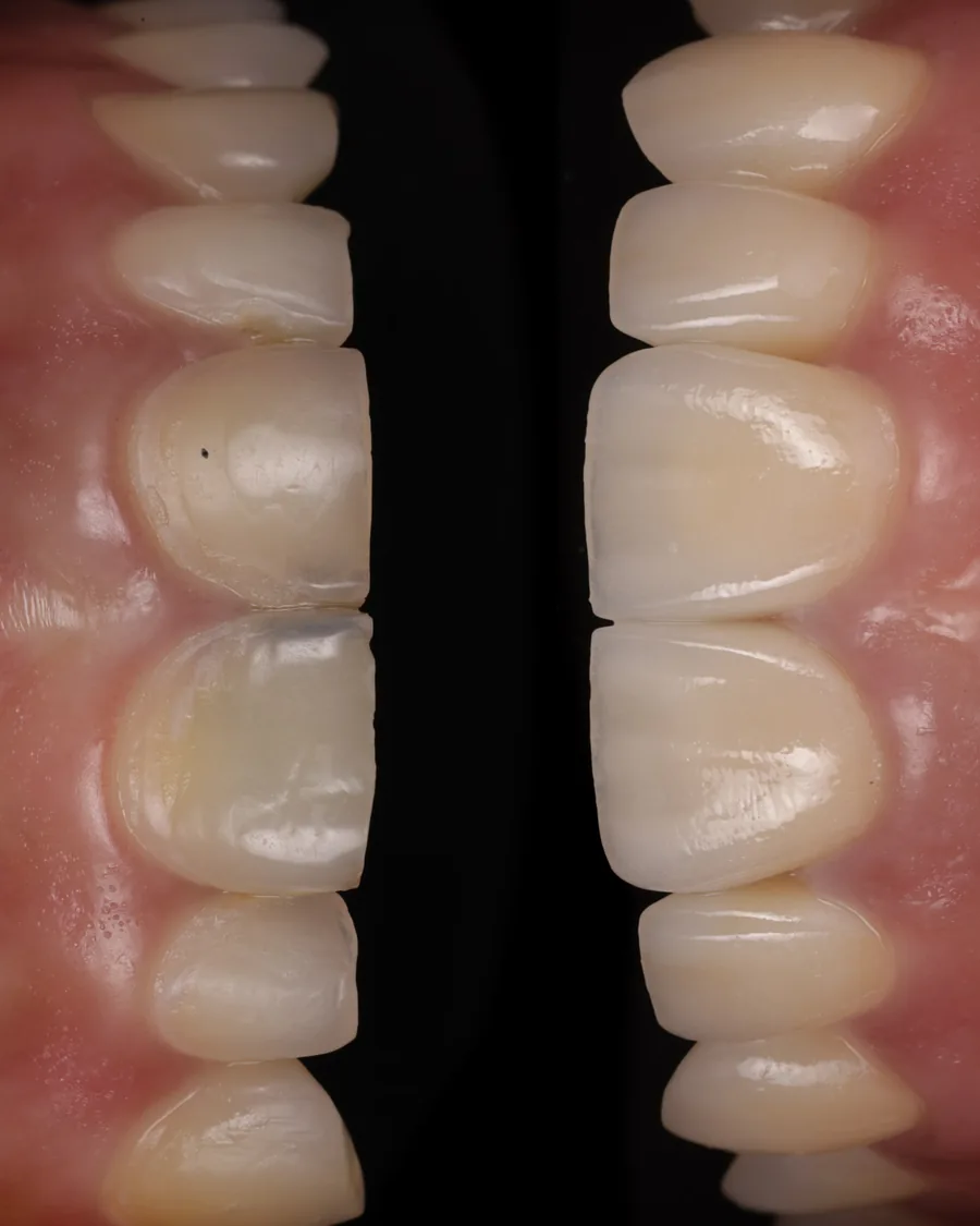 Photographie clinique illustrant des usures dentaires progressives, indication de facettes céramiques pour restaurer les bords libres
