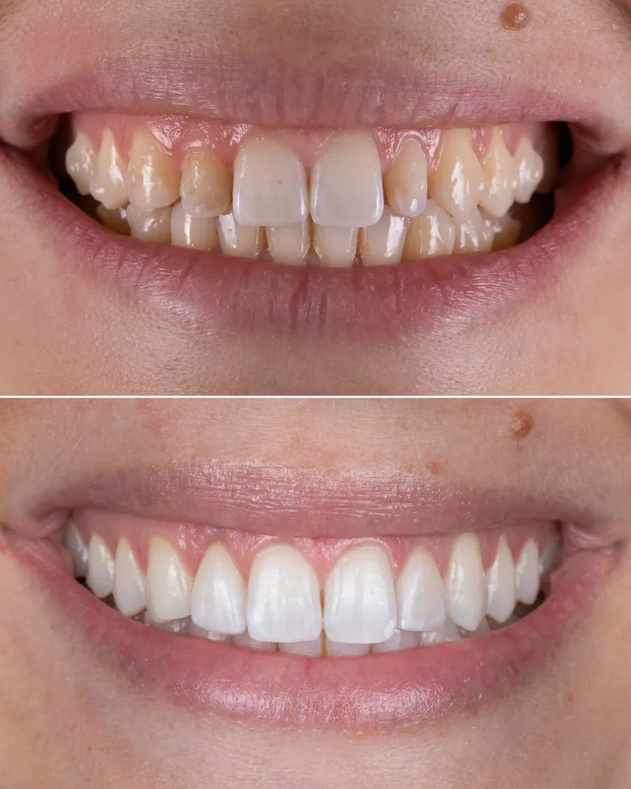 Asymétries gingivales corrigées par gingivectomie au cabinet du Dr Bruno Abehassera à Levallois-Perret