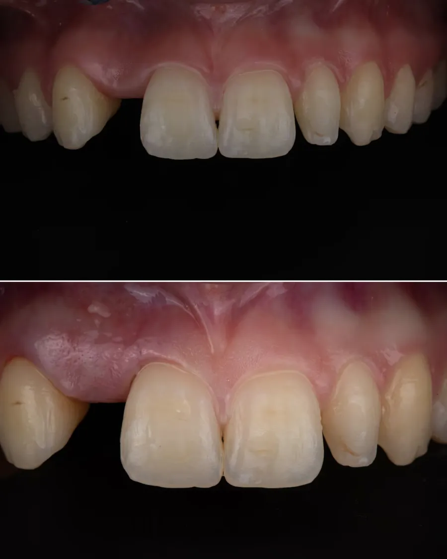 Insuffisance gingivale traitée par greffe gingivale au cabinet à Levallois-Perret — cas avant après