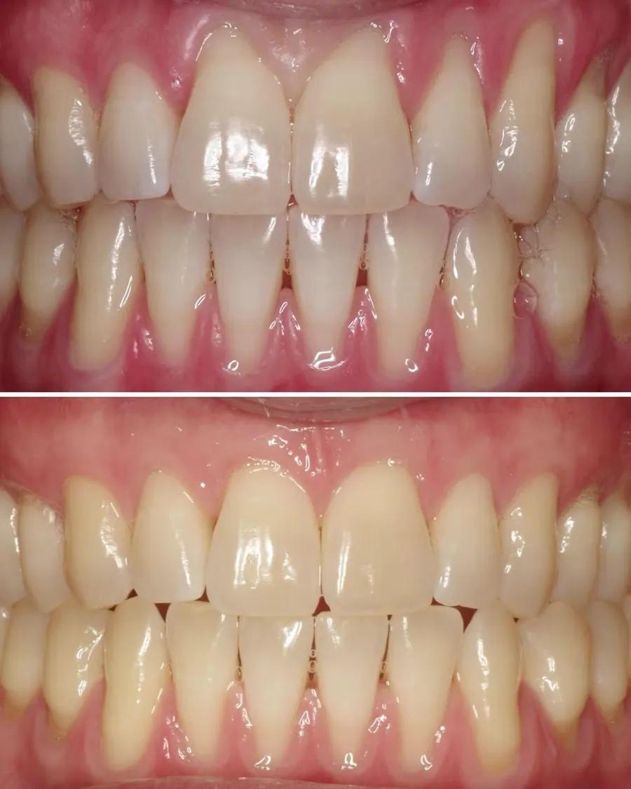Récessions gingivales traitées par greffe par tunnelisation au cabinet du Dr Bruno Abehassera