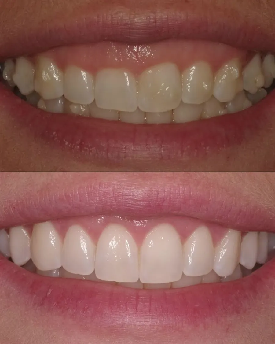 Sourire gingival traité par gingivectomie au cabinet à Levallois-Perret — cas avant après