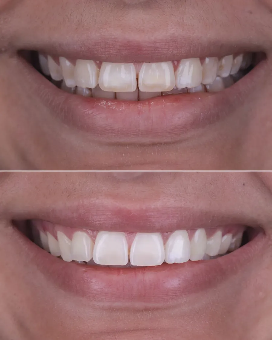 Sourire avant et après traitement Icon sur fluorose dentaire légère à modérée