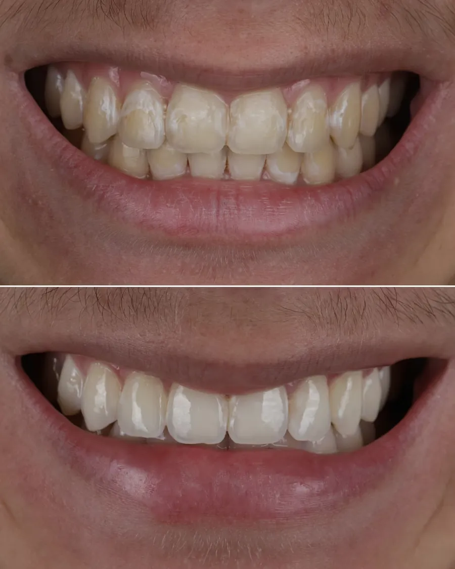 Cas clinique de white spots post-orthodontiques traités par technique Icon