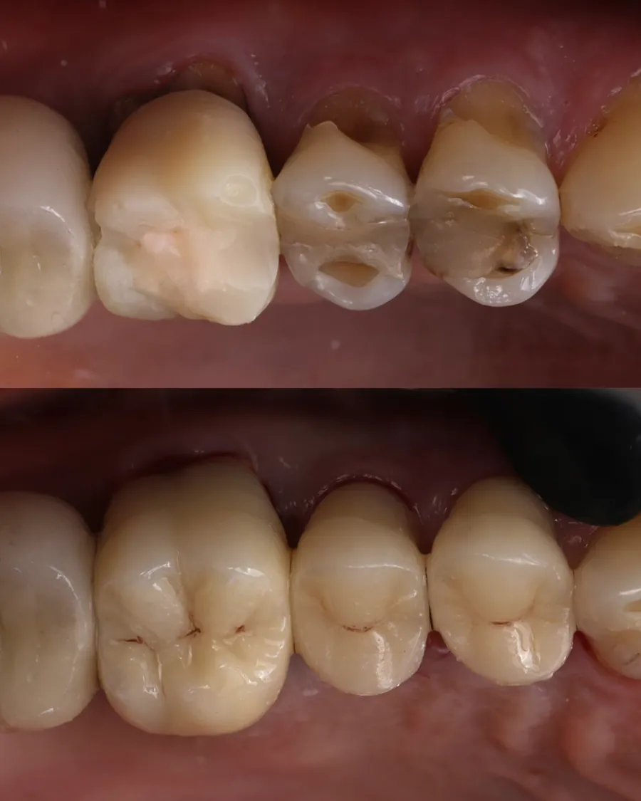 Cas clinique de reconstruction d'une dent usée par onlay céramique réalisé par le Dr Bruno Abehassera, avant et après traitement