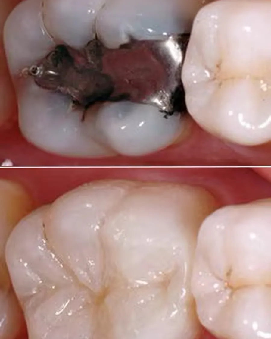 Cas clinique de remplacement d'un ancien amalgame ou composite dégradé par un onlay céramique, avant et après traitement
